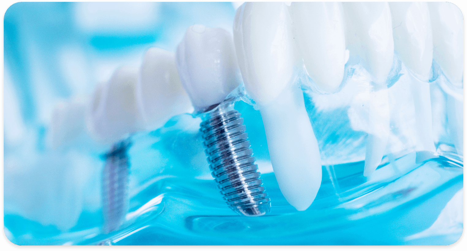 Prosthodontics | Alexandria | Stafford VA | Dental Crown | Dentures