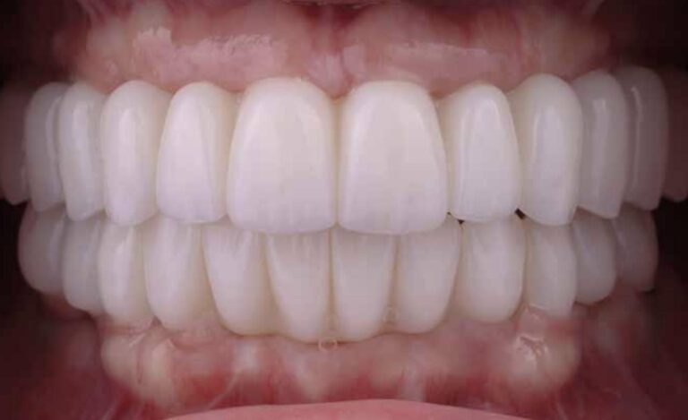 Everything You Need to Know About FP1 Full Arch Implants | Innova ...