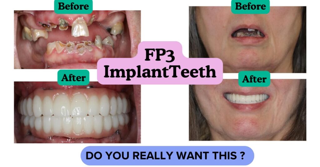 FP3 Implant Teeth - Do you Really want that